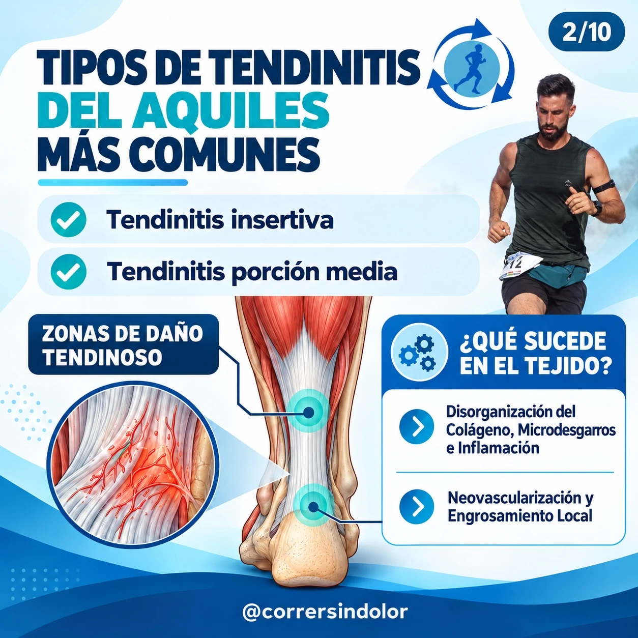 Tipos de tendinopatía del Aquiles más comunes: insercional y porción media